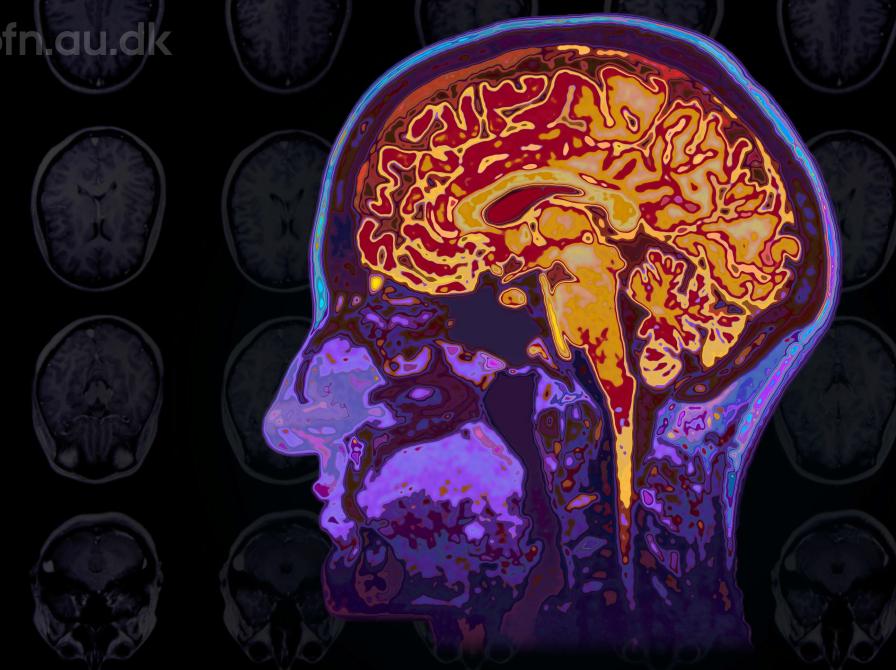 Billede af en scannet hjerne.